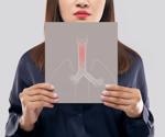 What is Subglottic Stenosis?