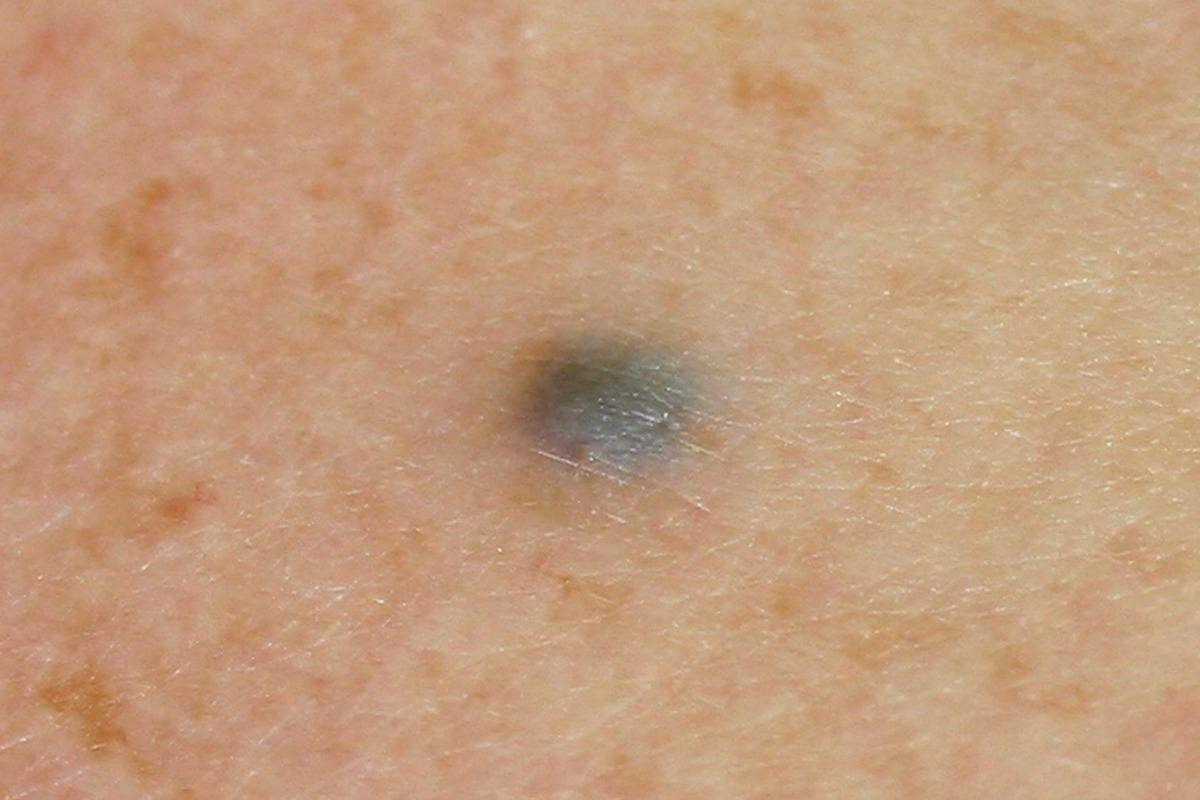 Image Credit: Dermatology11/Shutterstock