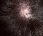 What is Aplasia Cutis Congenita?