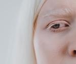 What is Chediak-Higashi Syndrome?