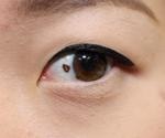 What is Ocular Melanoma?