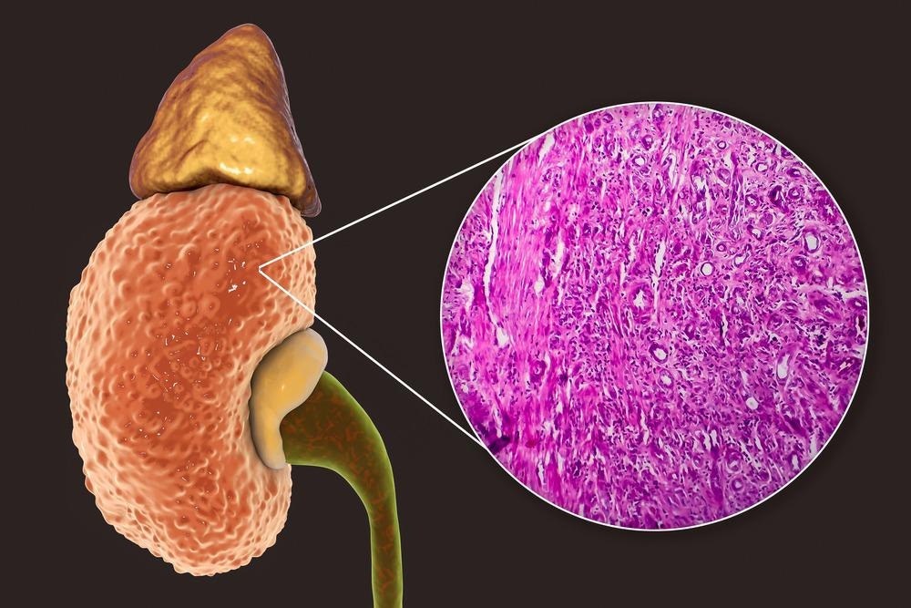 Chronic glomuleronephritis