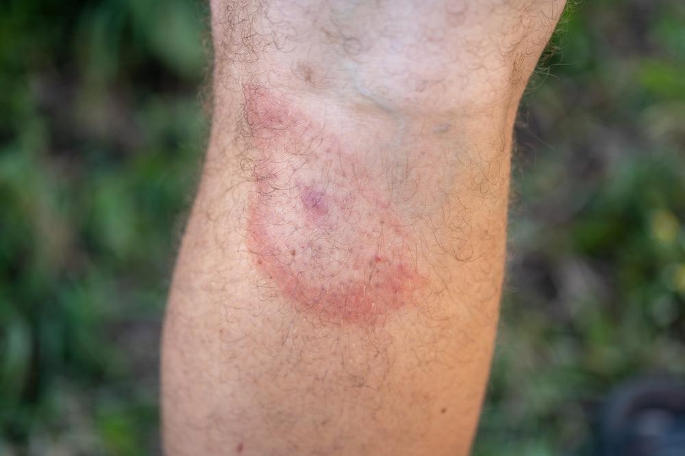 Tick bite