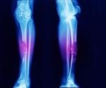 What is Ollier Disease?