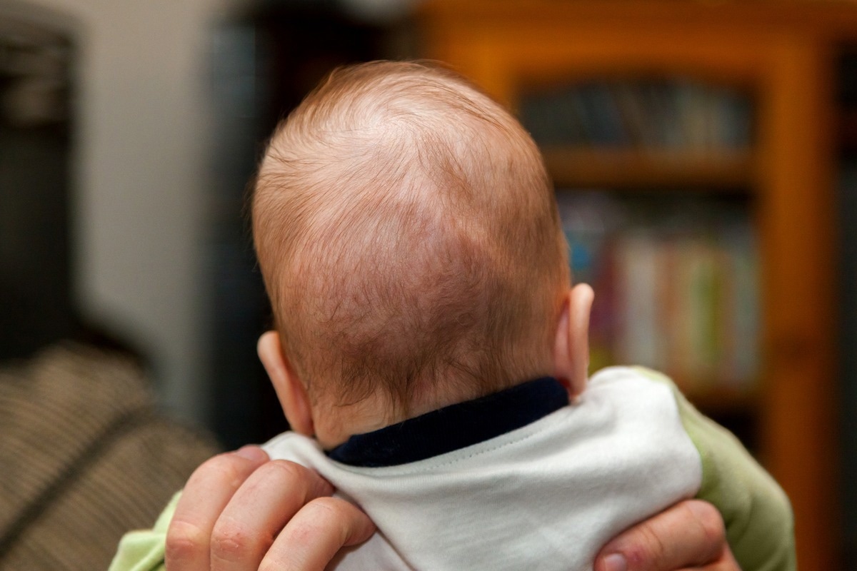 A baby with craniosynostosis - one of the main symptoms of the syndrome. Image Credit: In The Light Photography/Shutterstock