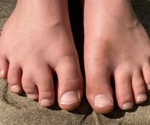 What is Jackson-Weiss Syndrome?