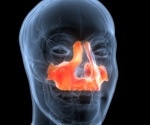 What is Binder Syndrome (Binder Type Nasomaxillary Dysplasia)?