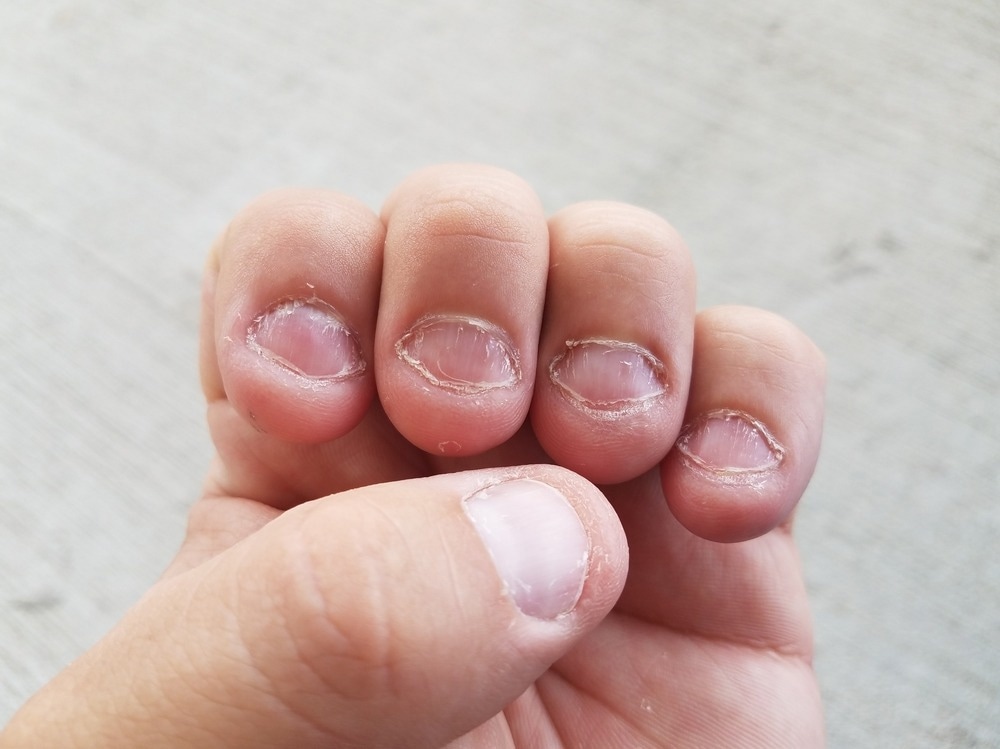 Nail biting
