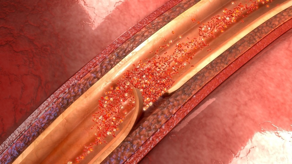 Aortic dissection