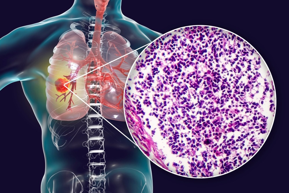 Small cell lung cancer