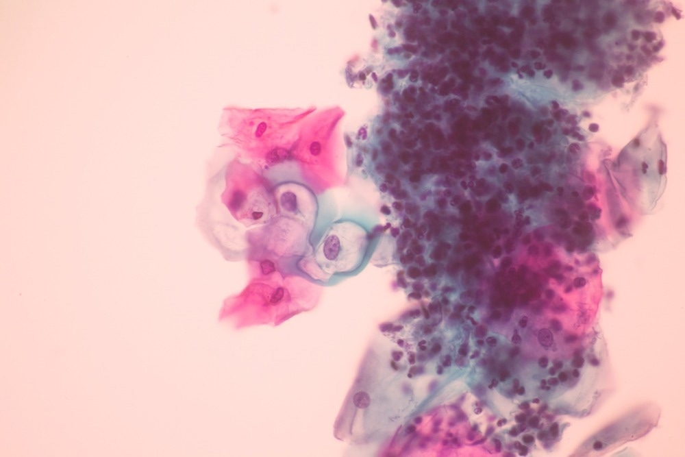 Abnormal Cells