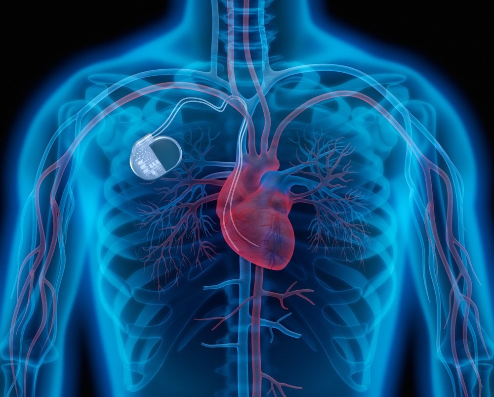 Pacemakers