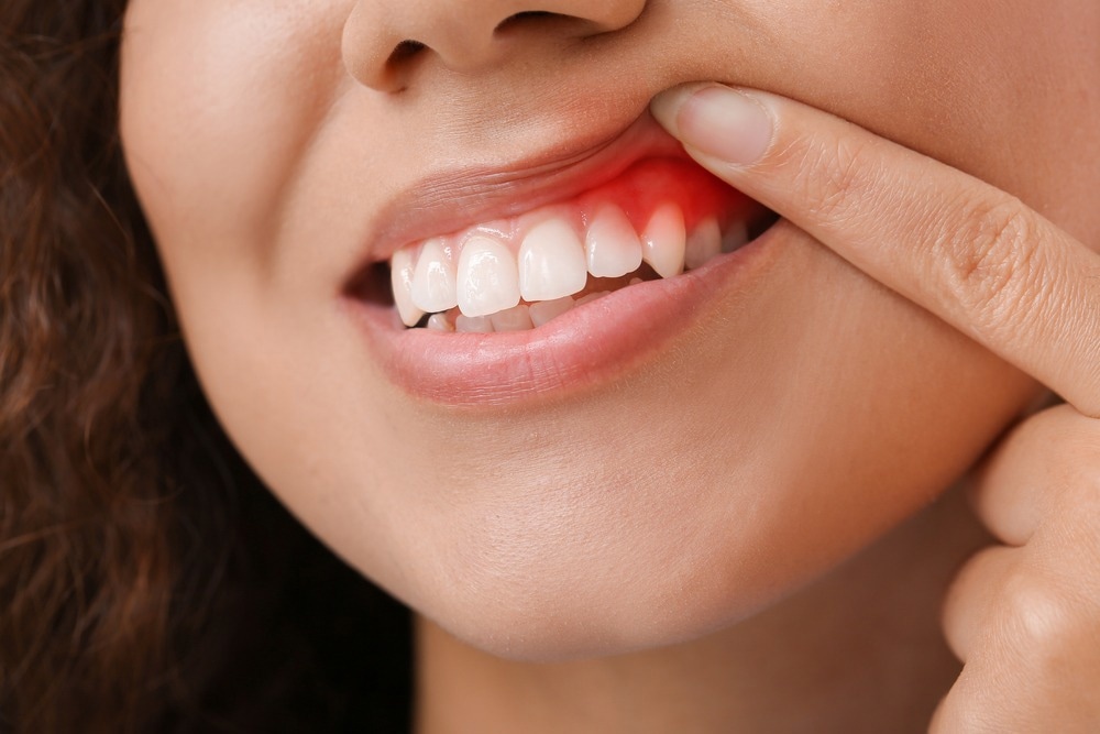 Gingivitis