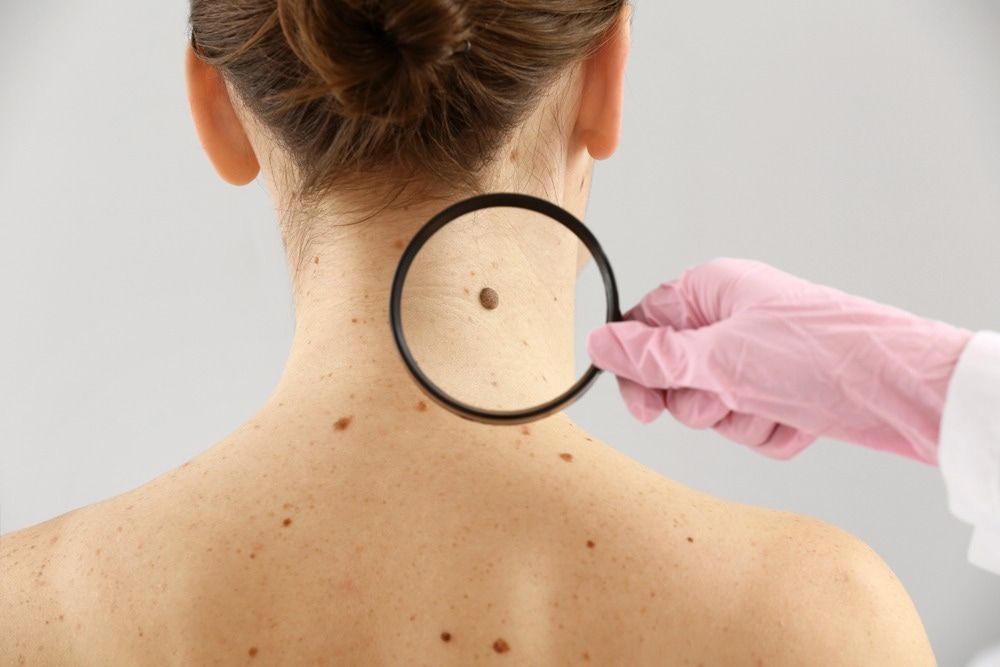 Melanoma
