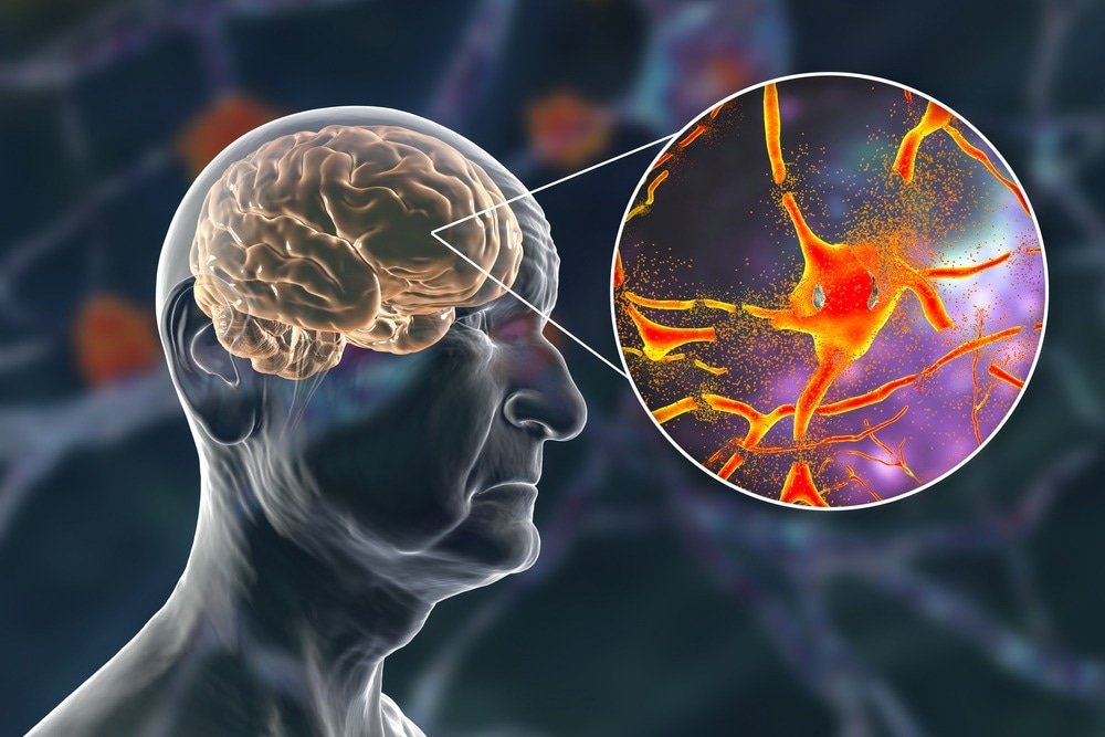 Dementia and Alzheimer