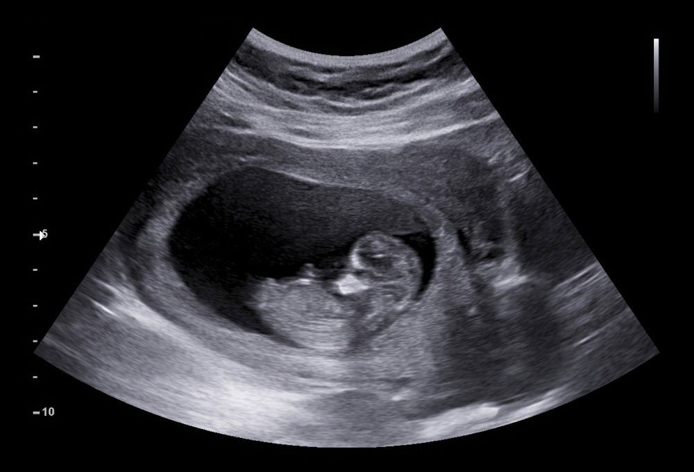 Fetus