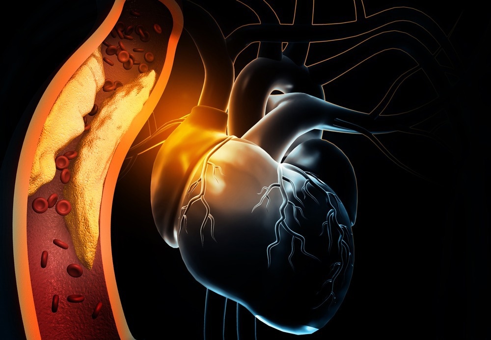 Myocardial Infarction