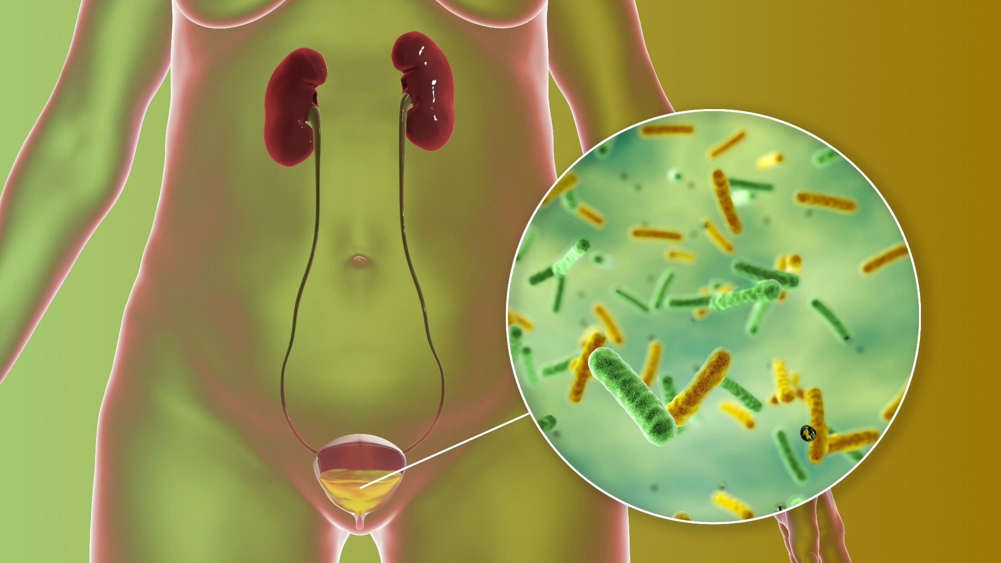 Urinary tract infection