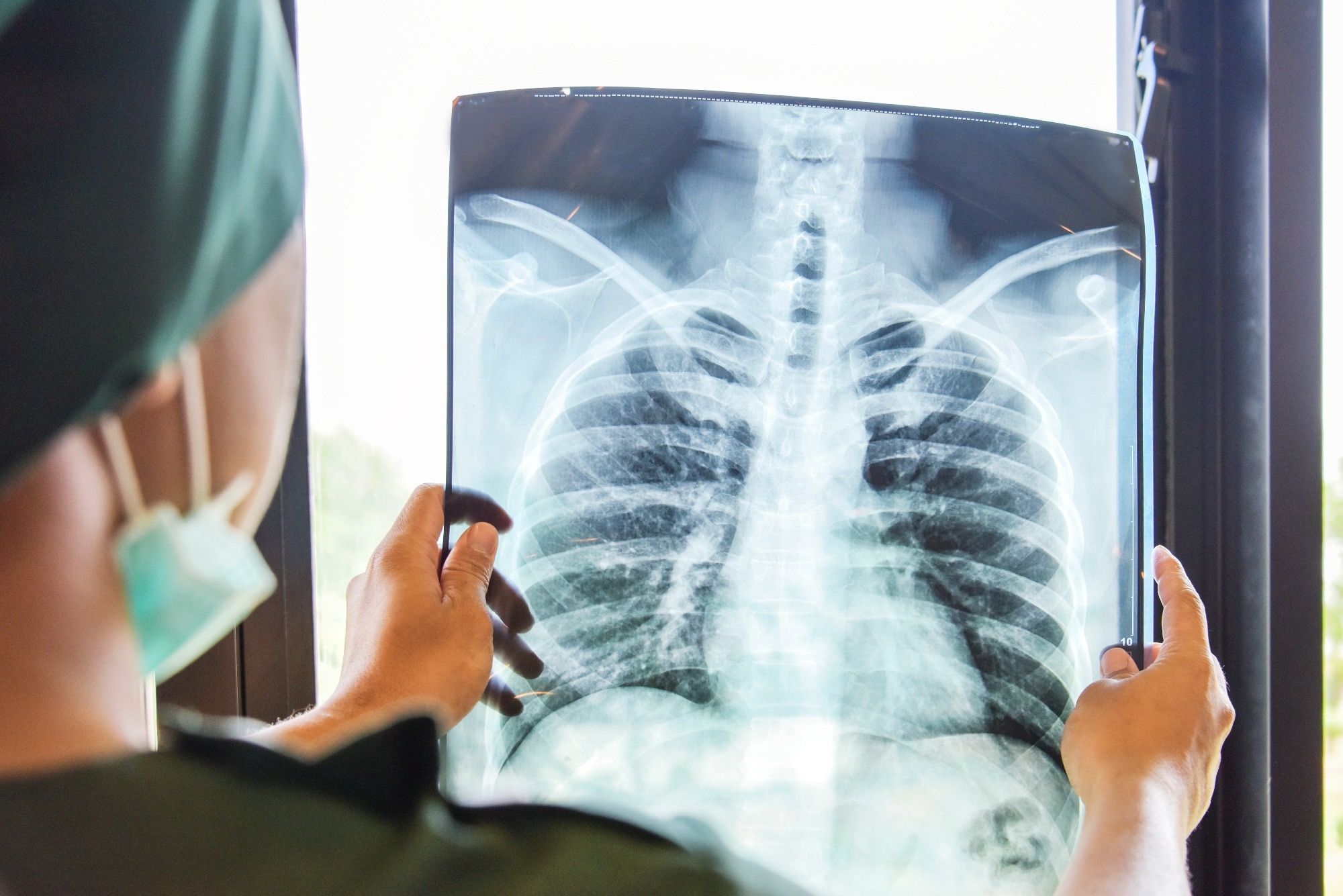 Non-cystic fibrosis bronchiectasis