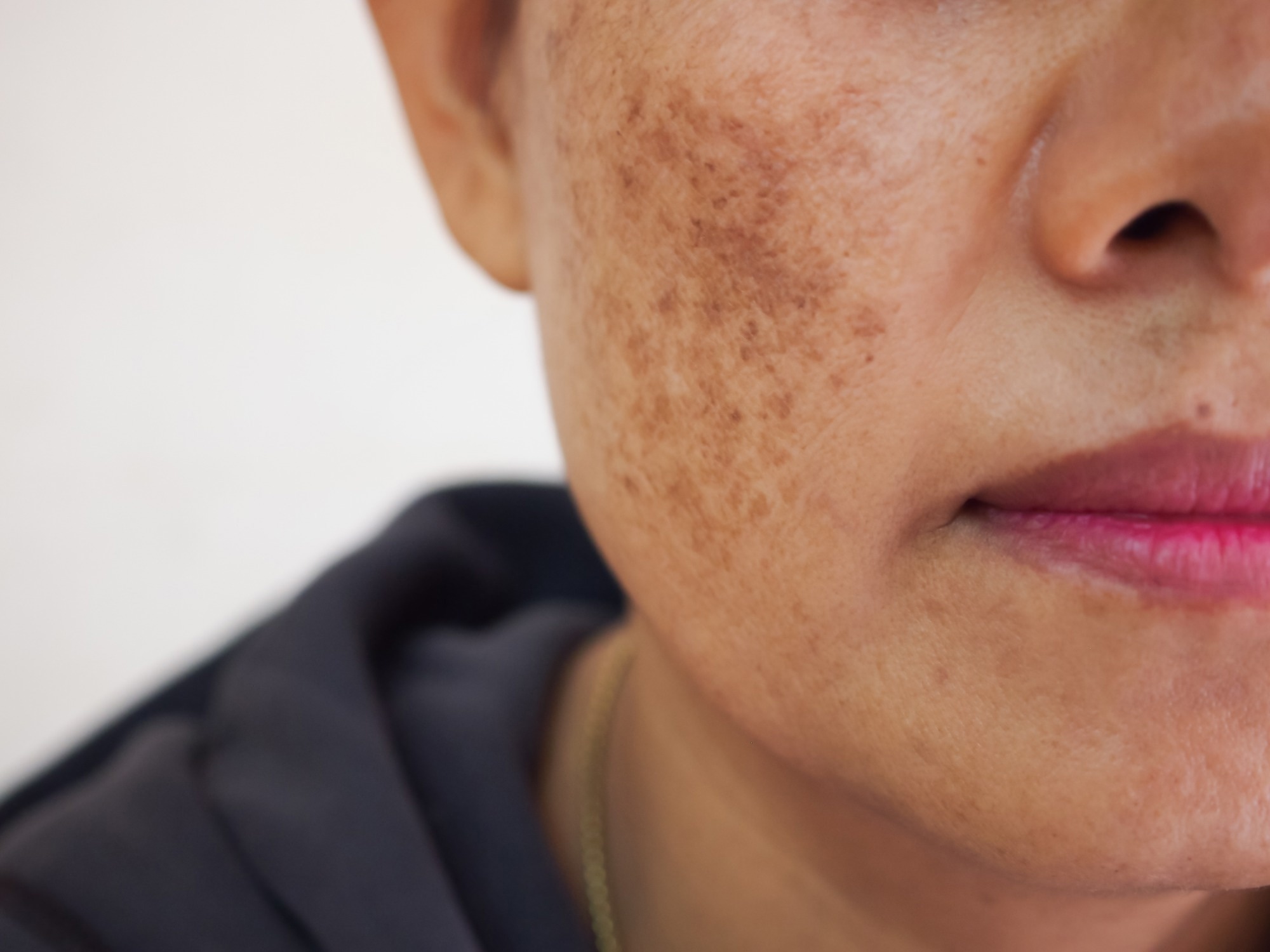 freckles