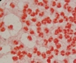 The Impact of Antimicrobial Resistance on STDs