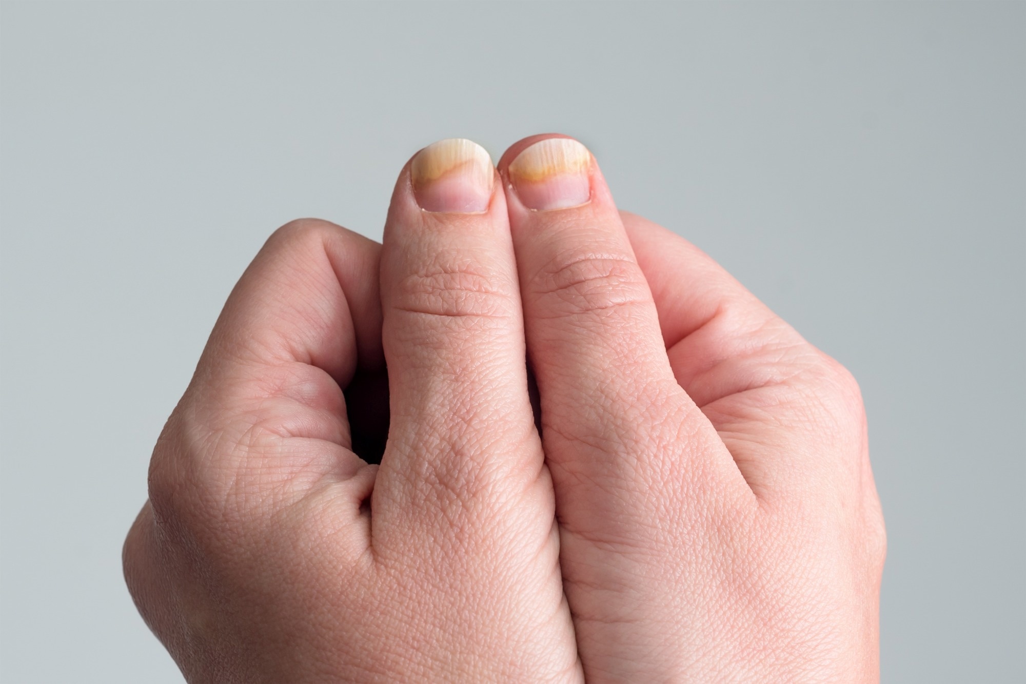 Longitudinal ridging nails with psoriasis.