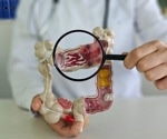 Why More Young Adults Are Getting Colorectal Cancer