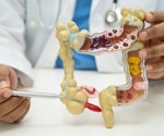Appendix Cancer on the Rise: Implications for Diagnosis and Patient Care