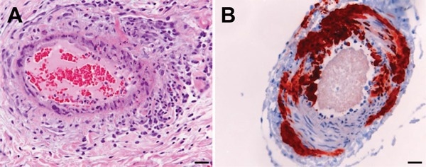 Histologic and immunohistologic findings in Hendra virus–infected horse tissue. A) Hematoxylin and eosin staining shows systemic vasculitis affecting the lung. B) Immunohistologic examination, using polyclonal rabbit anti-Nipah N protein, indicates Hendra virus antigen in a blood vessel in the brain. Scale bars represent 50 μm. 15