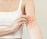 Eczema Research