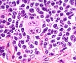 Hodgkin's Lymphoma Classification