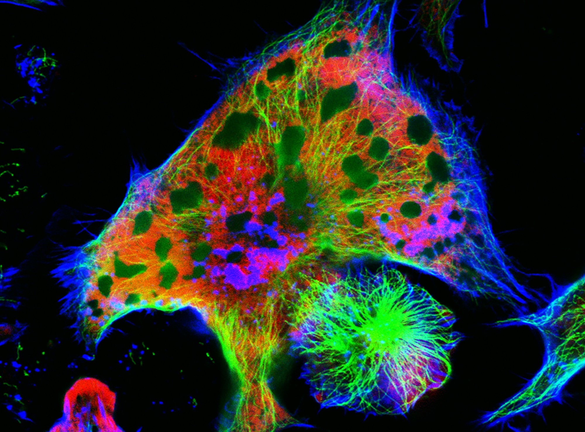 neuroblastoma