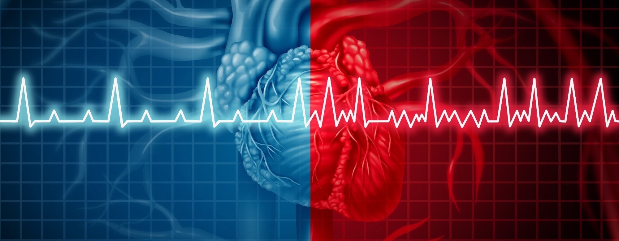 Exercise-based cardiac rehab cuts atrial fibrillation recurrence and boosts quality of life, study finds