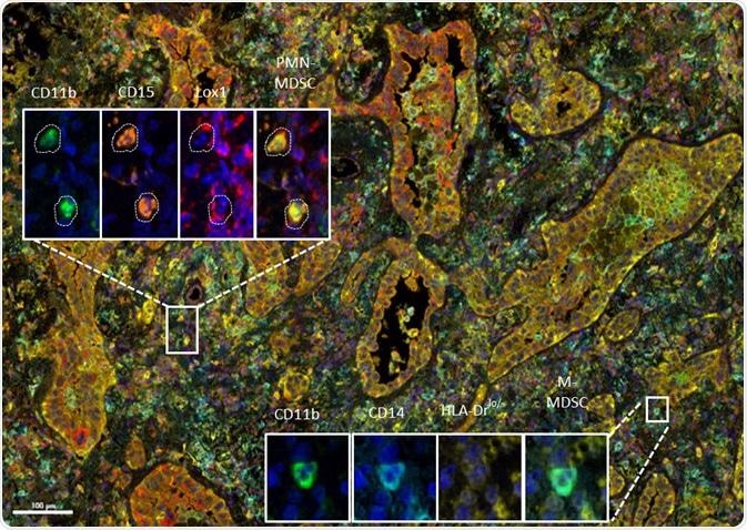 MDSC multiplex immunohistochemistry (IHC) panel developed at Cerba Research applied to non-small-cell lung cancer tissue. The high level of phenotyping allows the distinction between subtypes on a single tissue section. Shown: polymorphonuclear (PMN) myeloid-derived suppressor cells (MDSC) and mononuclear (M) MDSC.