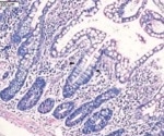 A critical target for chronic gastrointestinal disorders: Integrin 4/7 (LPAM-1)