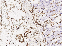 How tumor exosomes communicate cancer progression