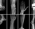 Detection of cancer and infections using Raman for point-of-care