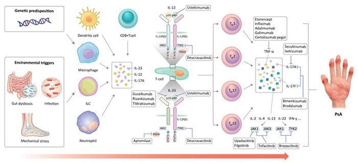 Psoriatic arthritis.