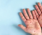 Infection control strategies to address the mpox outbreak