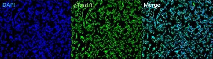 Immunofluorescence Staining of p-Tau181 Antibody in SH-SY5Y Cells