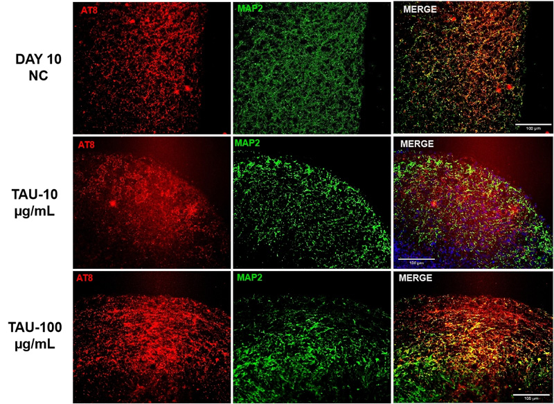 Immunofluorescence staining of AT8 and MAP2 in brain organoids treated with different concentrations of Tau PFFs
