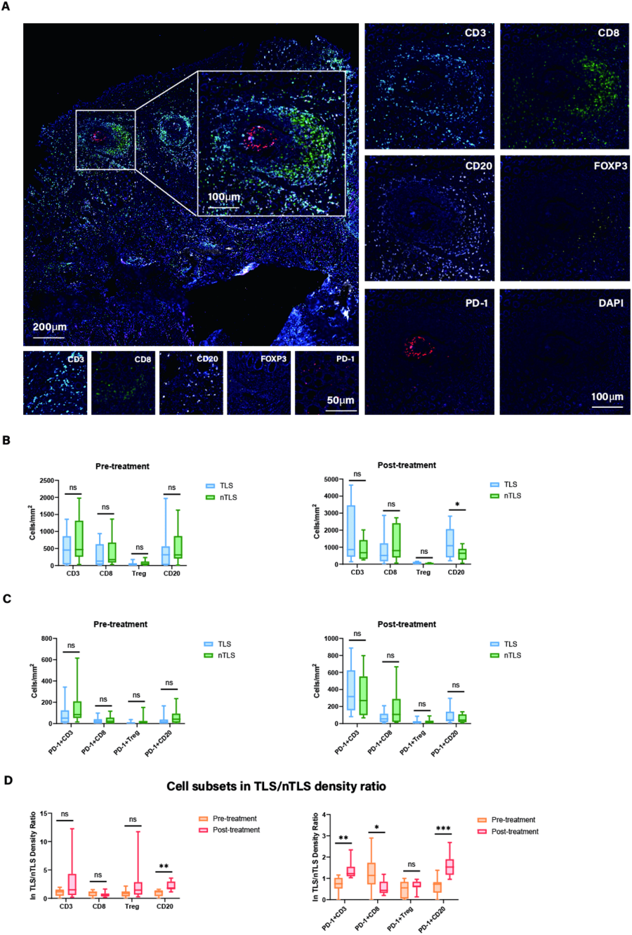 From Figure 5. Liu X, Xu D, Zhou C, Zhong Y, Geng H, Huang C, Shen Y, Xia X, Wang C, Zhu C, Cao H. Association of PD-1 + Treg/PD-1 + CD8 ratio and tertiary lymphoid structures with prognosis and response in advanced gastric cancer patients receiving preoperative treatment