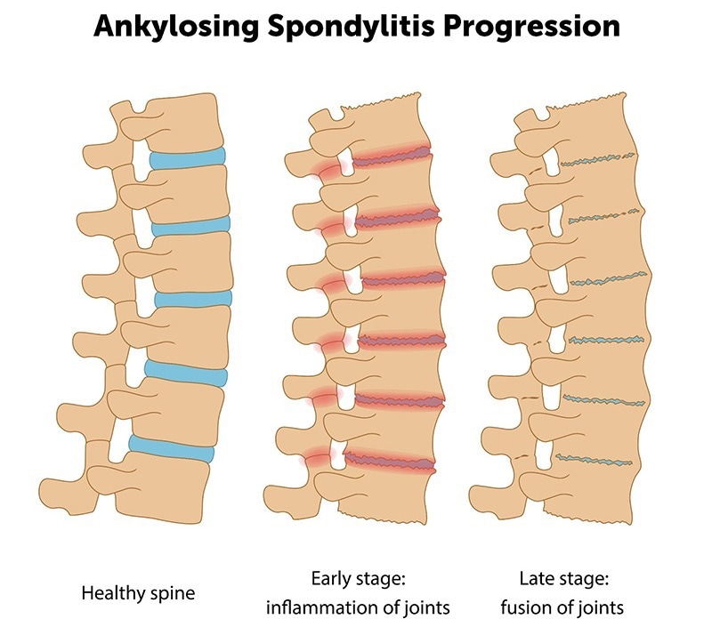 Progression of AS