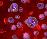 Supporting earlier diagnosis of multiple myeloma with serum free light chain assays