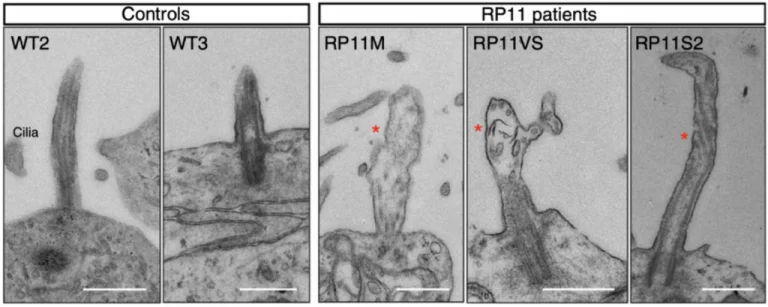 Transmission electron microscopy images showing shorter cilia in patient-derived photoreceptors, with abnormal bulbous morphology (red star). Scale bar (500 nm).