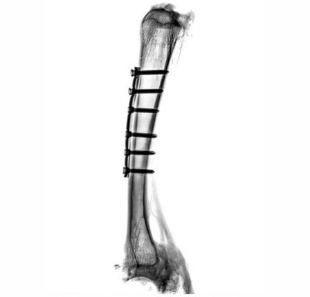 Implants on a sheep bone. The fit of the implants, the progress of healing and fissures on the screw connections are clearly visible.