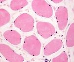 Sarcopenia and COVID-19