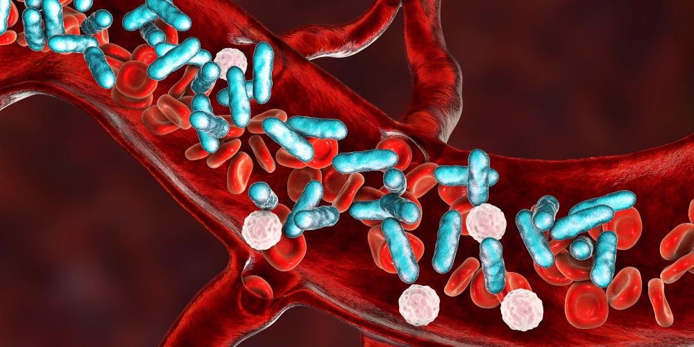 Sepsis