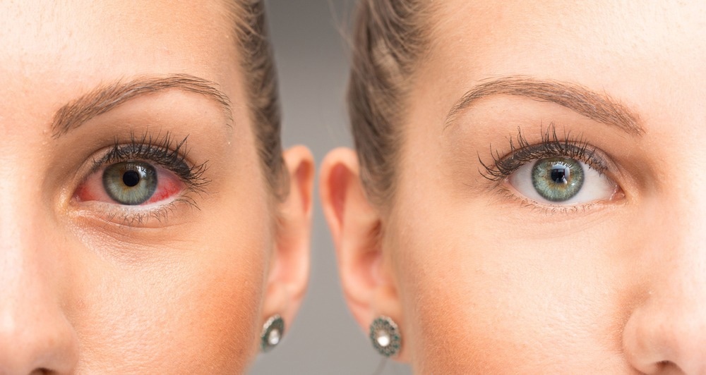 Dry Eye Disease