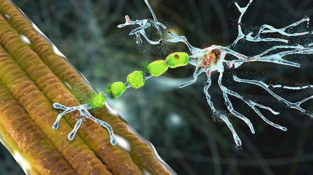 amyotrophic lateral sclerosis